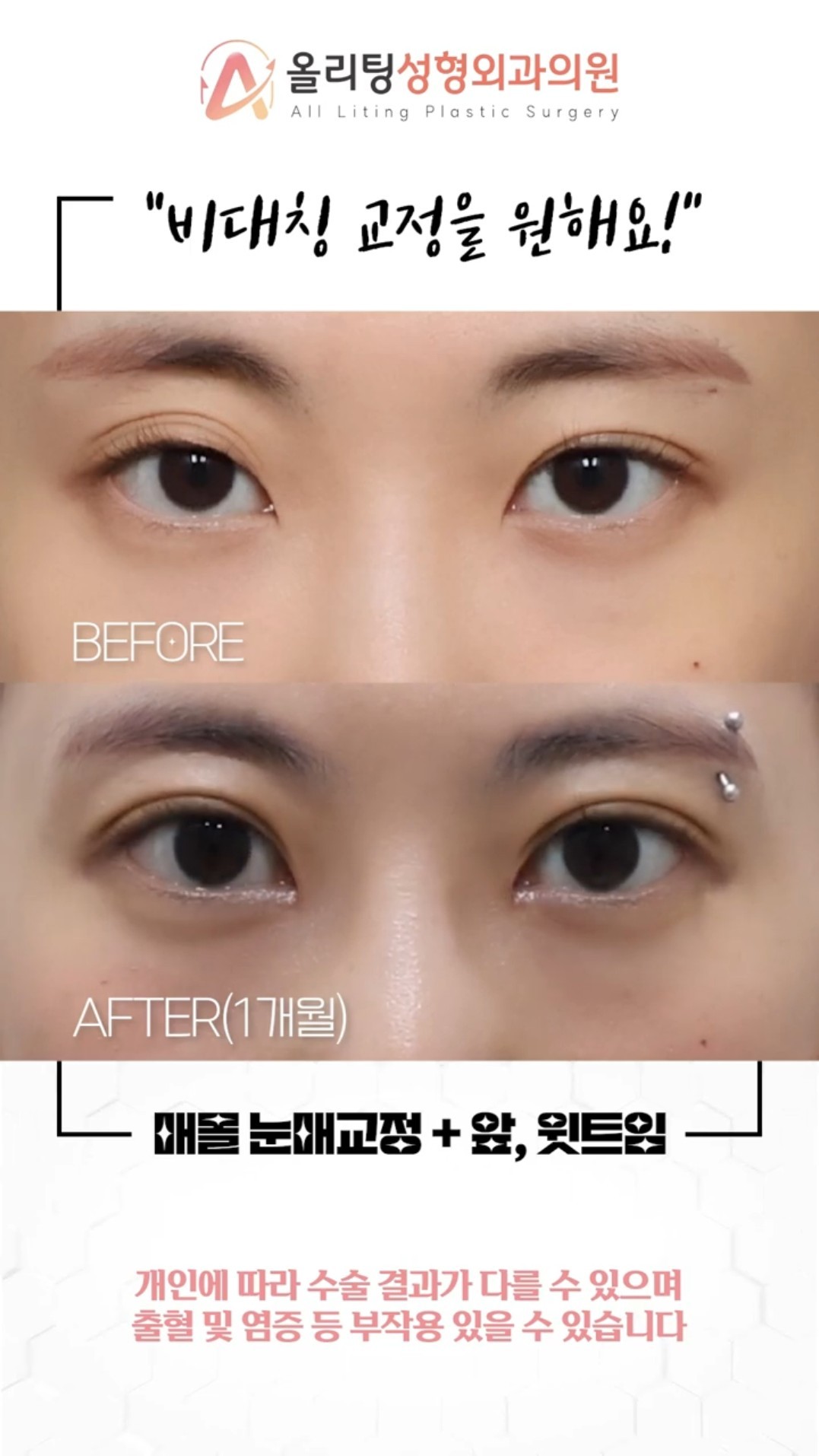 allliting plastic surgery shorts video woman eye surgery