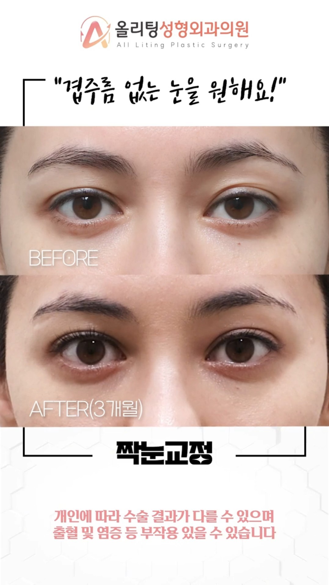allliting plastic surgery shorts video woman eye surgery