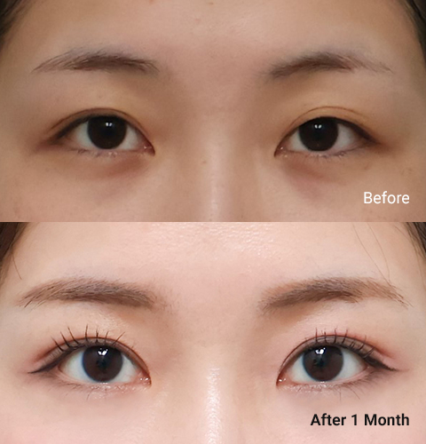 AllLiting Plastic Surgery eye before & after 01