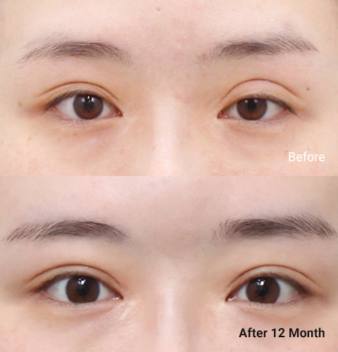AllLiting Plastic Surgery eye before & after 02