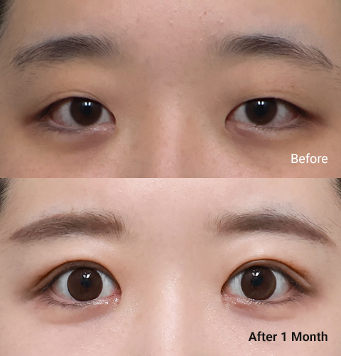AllLiting Plastic Surgery eye before & after 03
