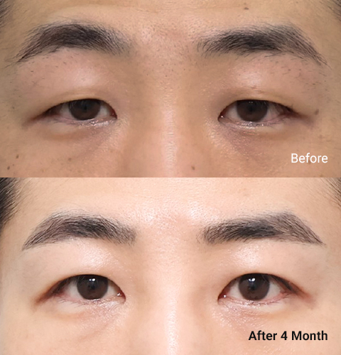 AllLiting Plastic Surgery eye before & after 04