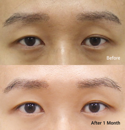 AllLiting Plastic Surgery eye before & after 05