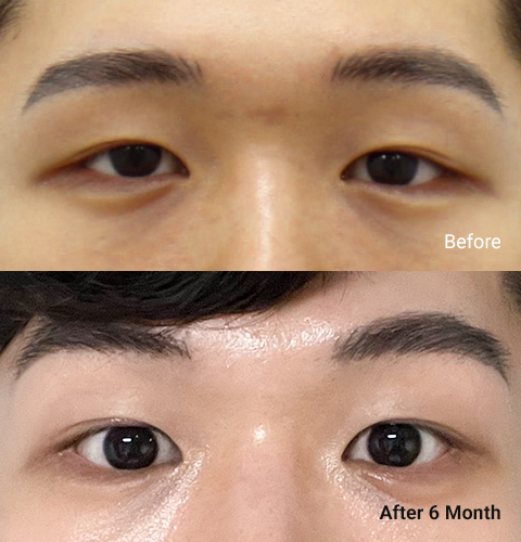 AllLiting Plastic Surgery eye before & after 06
