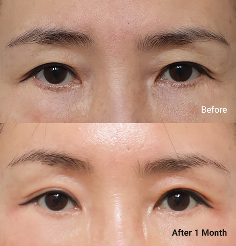 AllLiting Plastic Surgery eye before & after 07