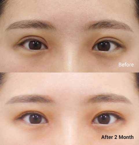 AllLiting Plastic Surgery eye before & after 08