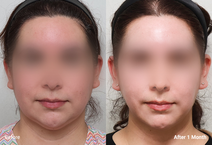 AllLiting Plastic Surgery lifting before & after 01