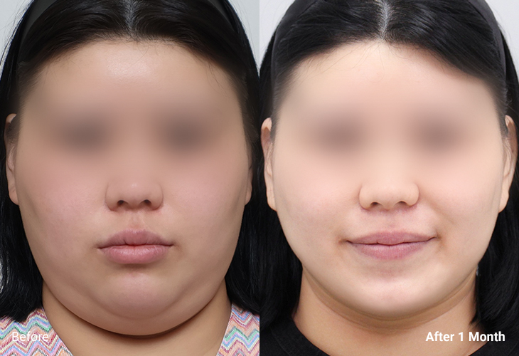 AllLiting Plastic Surgery lifting before & after 02