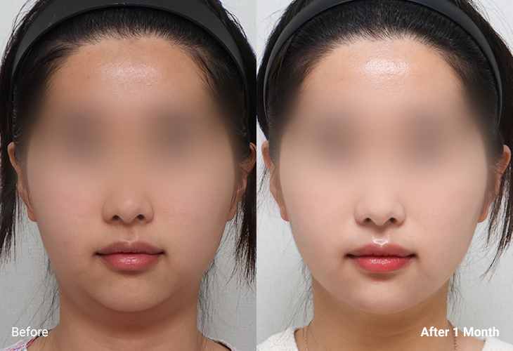 AllLiting Plastic Surgery lifting before & after 03