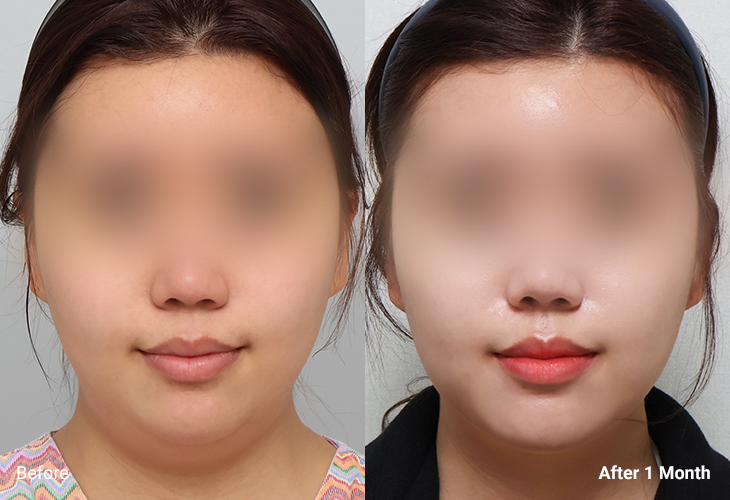 AllLiting Plastic Surgery lifting before & after 04
