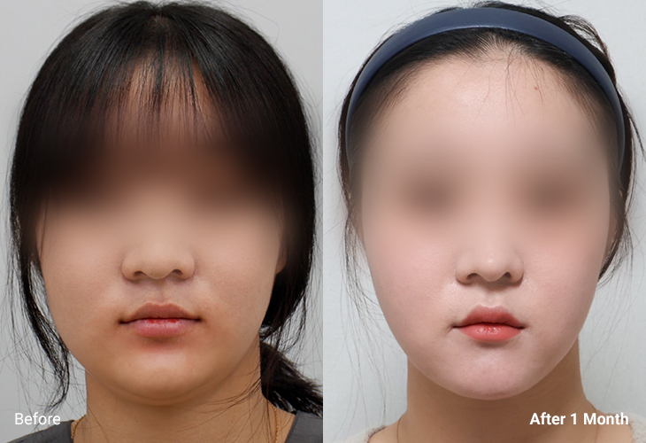 AllLiting Plastic Surgery lifting before & after 05