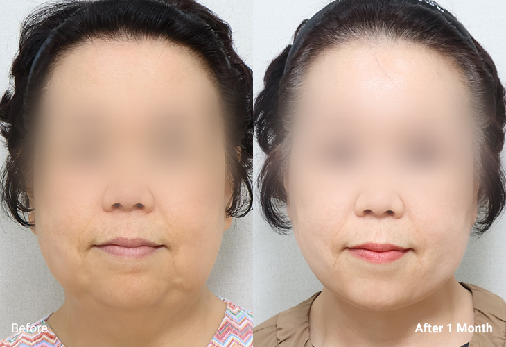 AllLiting Plastic Surgery lifting before & after 06