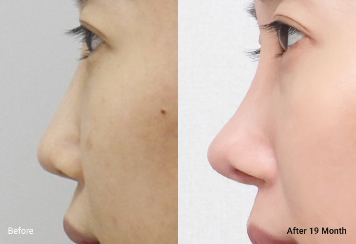 AllLiting Plastic Surgery nose before & after 01