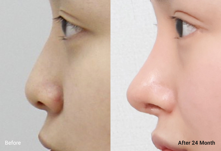 AllLiting Plastic Surgery nose before & after 02