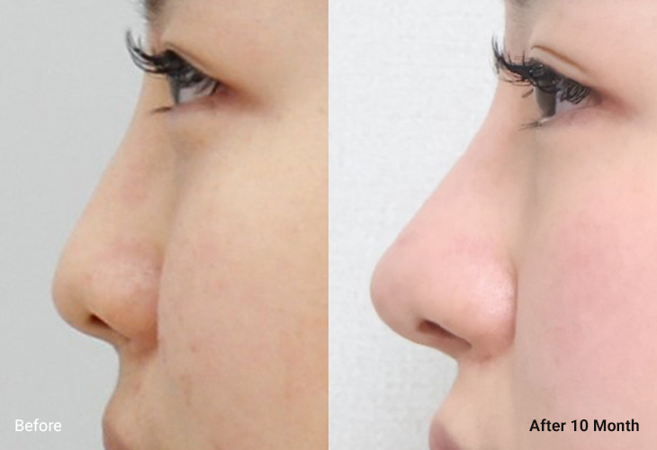 AllLiting Plastic Surgery nose before & after 03