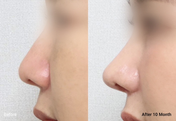 AllLiting Plastic Surgery nose before & after 04