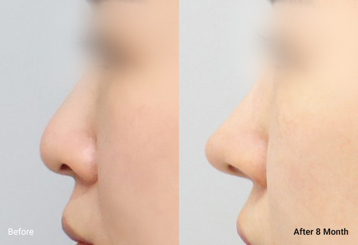 AllLiting Plastic Surgery nose before & after 05