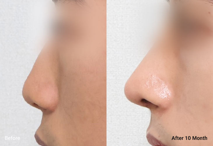 AllLiting Plastic Surgery nose before & after 06